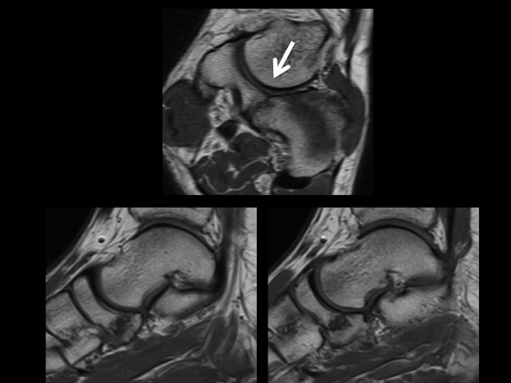 Figure 2 for case navicular-cuboid coalition
